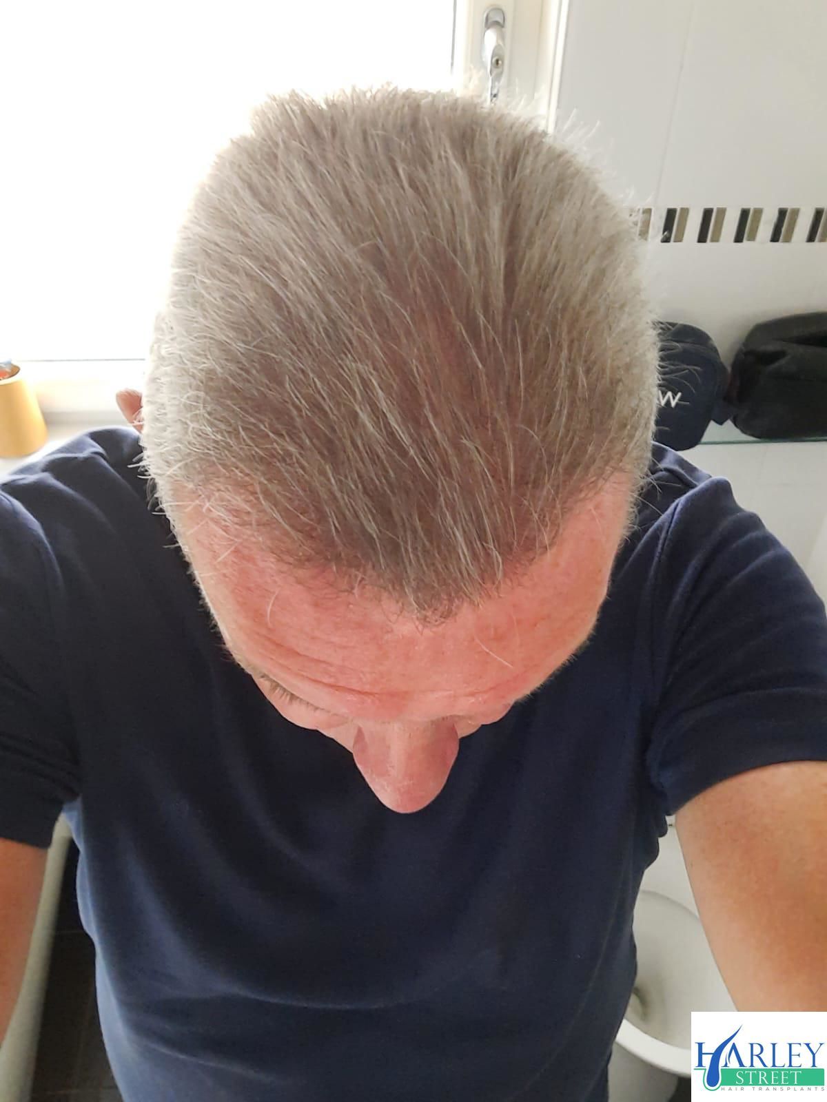 A picture of a patient after a crown hair transplant