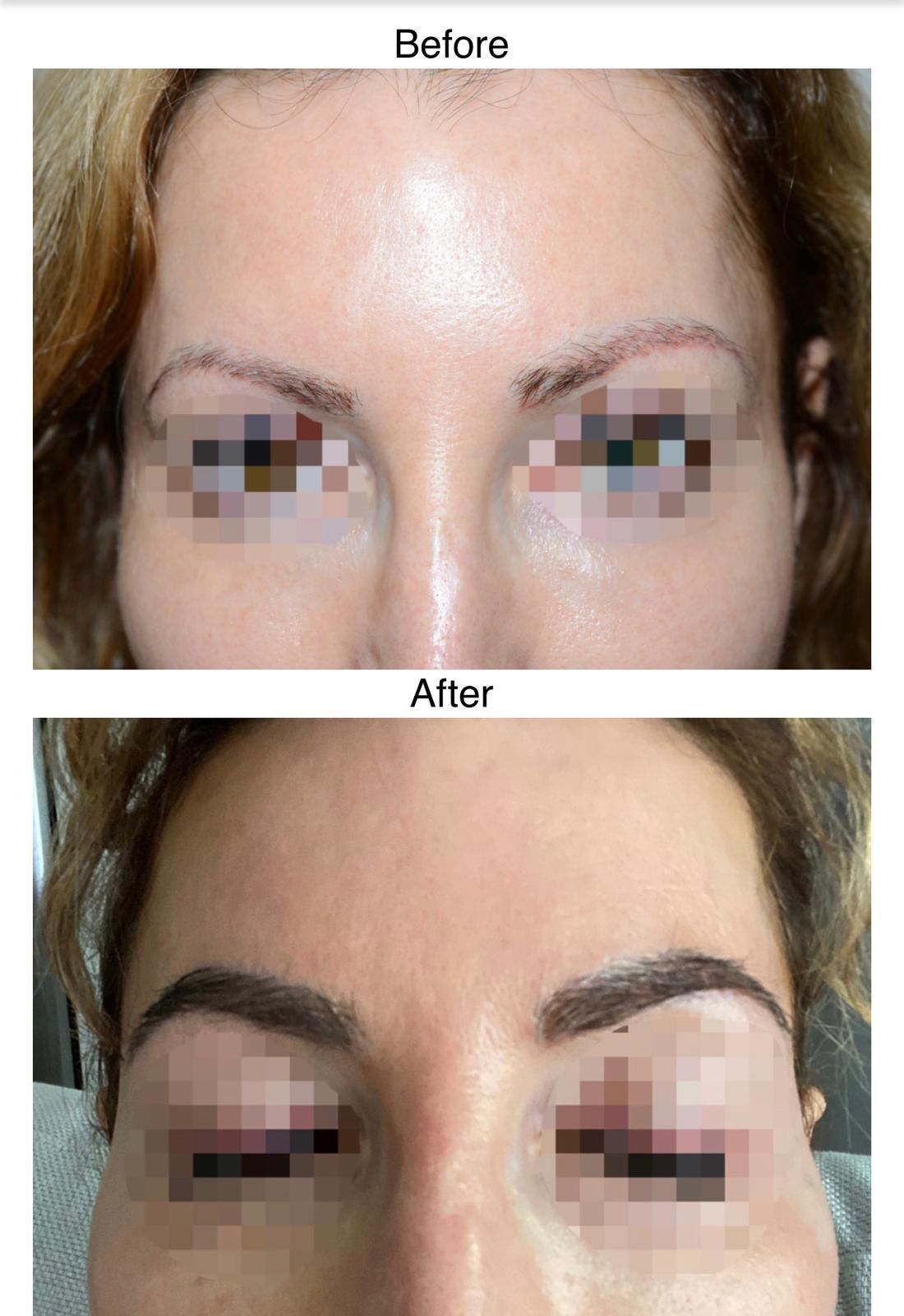 Liverpool eyebrow hair transplant after image 1