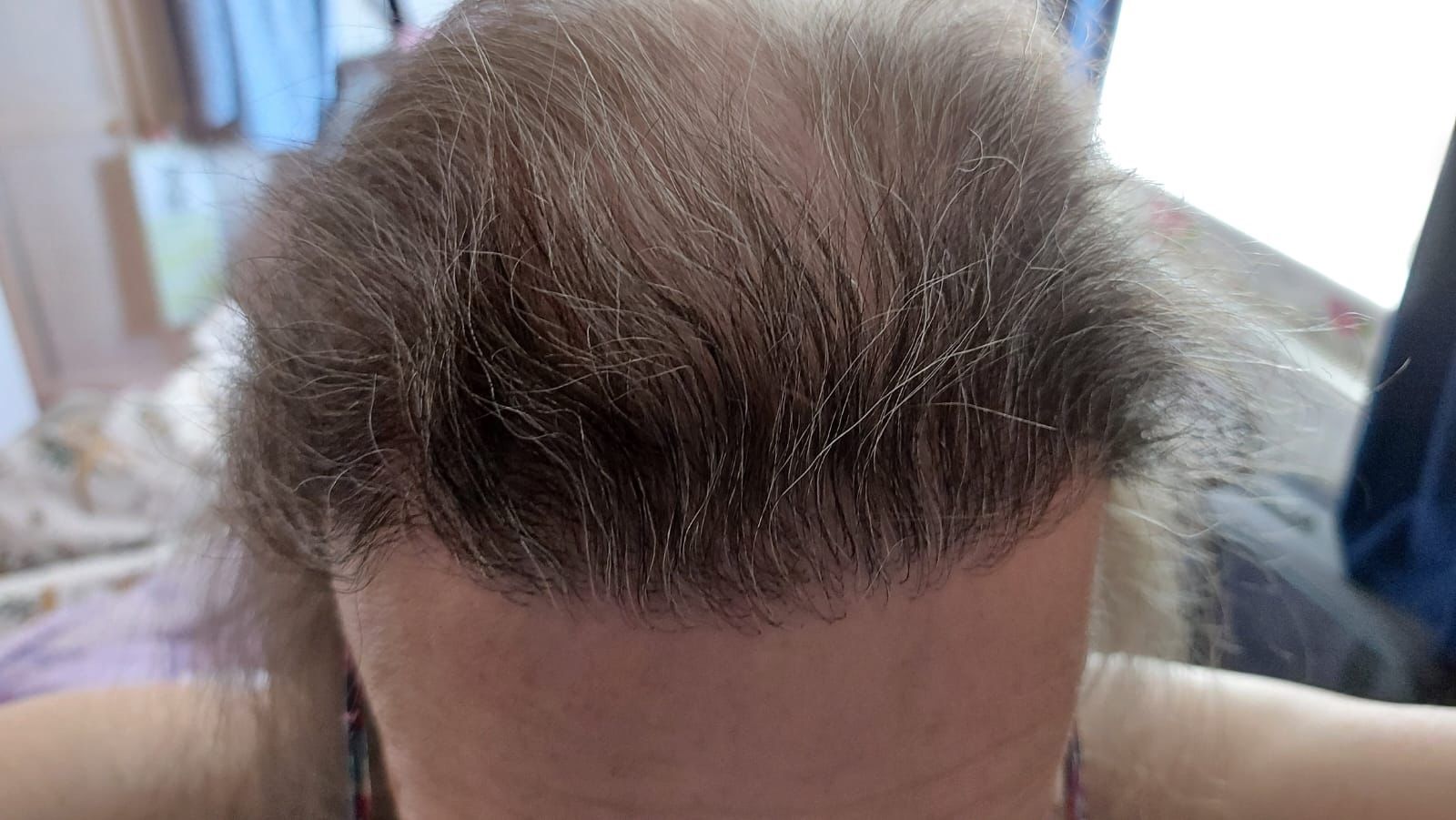 Liverpool FUE hair transplant result image 2