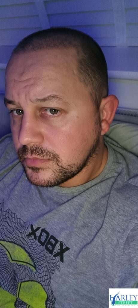 A picture of a hair transplant carried out by Harley Street hair transplants Liverpool