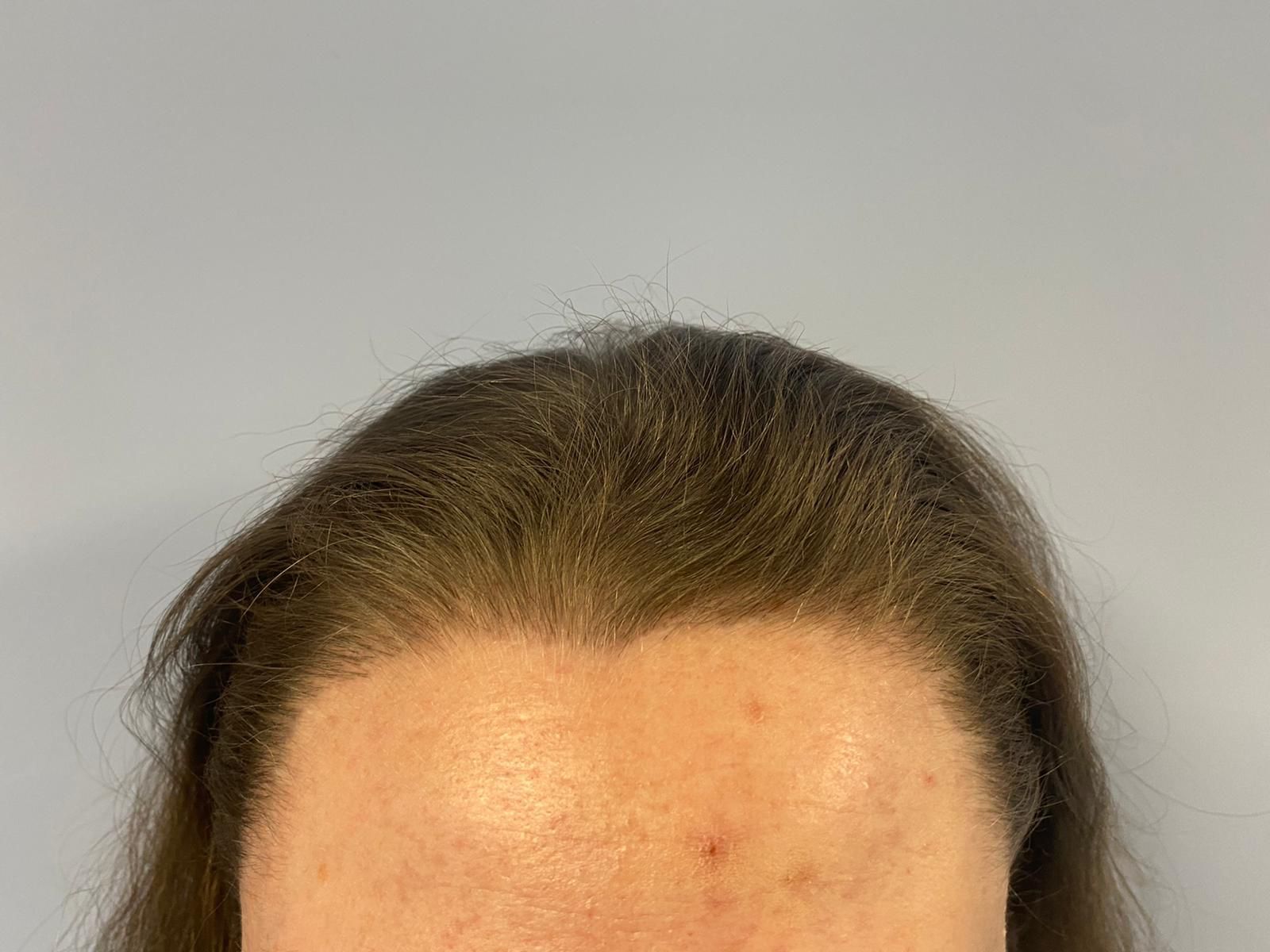 A female patient after undergoing a FUE hair transplant