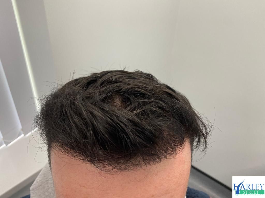 A picture of a hair transplant carried out by Harley Street Hair Transplant Liverpool