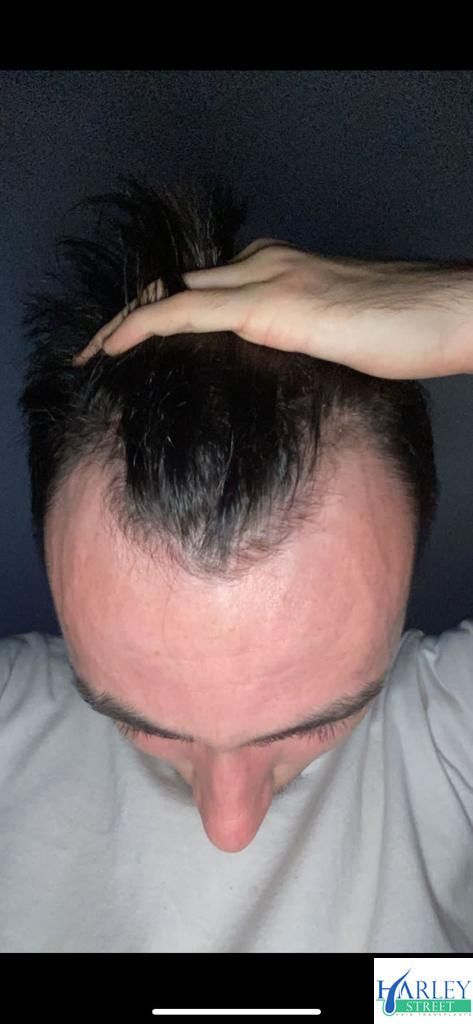 A picture of a hair transplant Liverpool patient showing signs of male pattern baldness