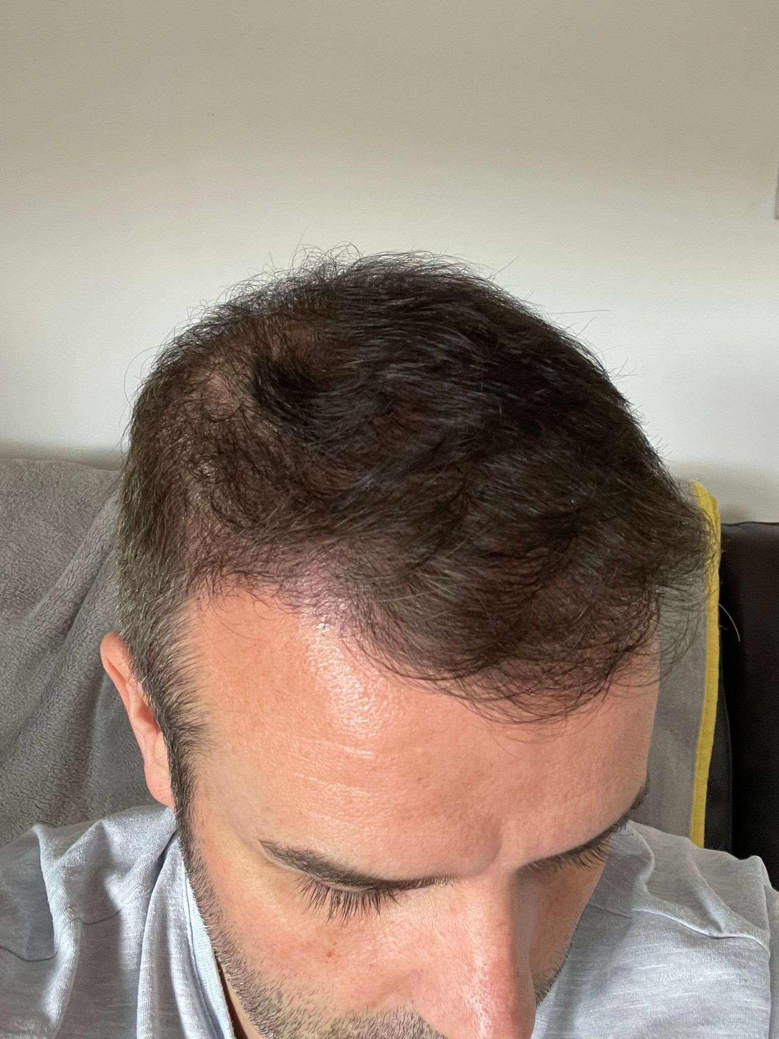 a picture of a patient after a crown hair transplant