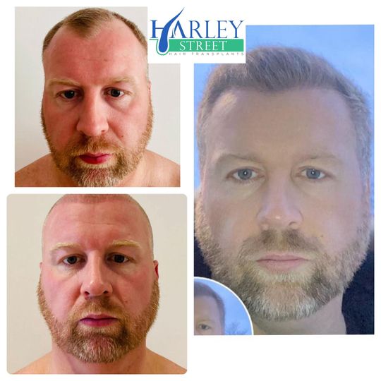 Liverpool hair transplant patient image 2