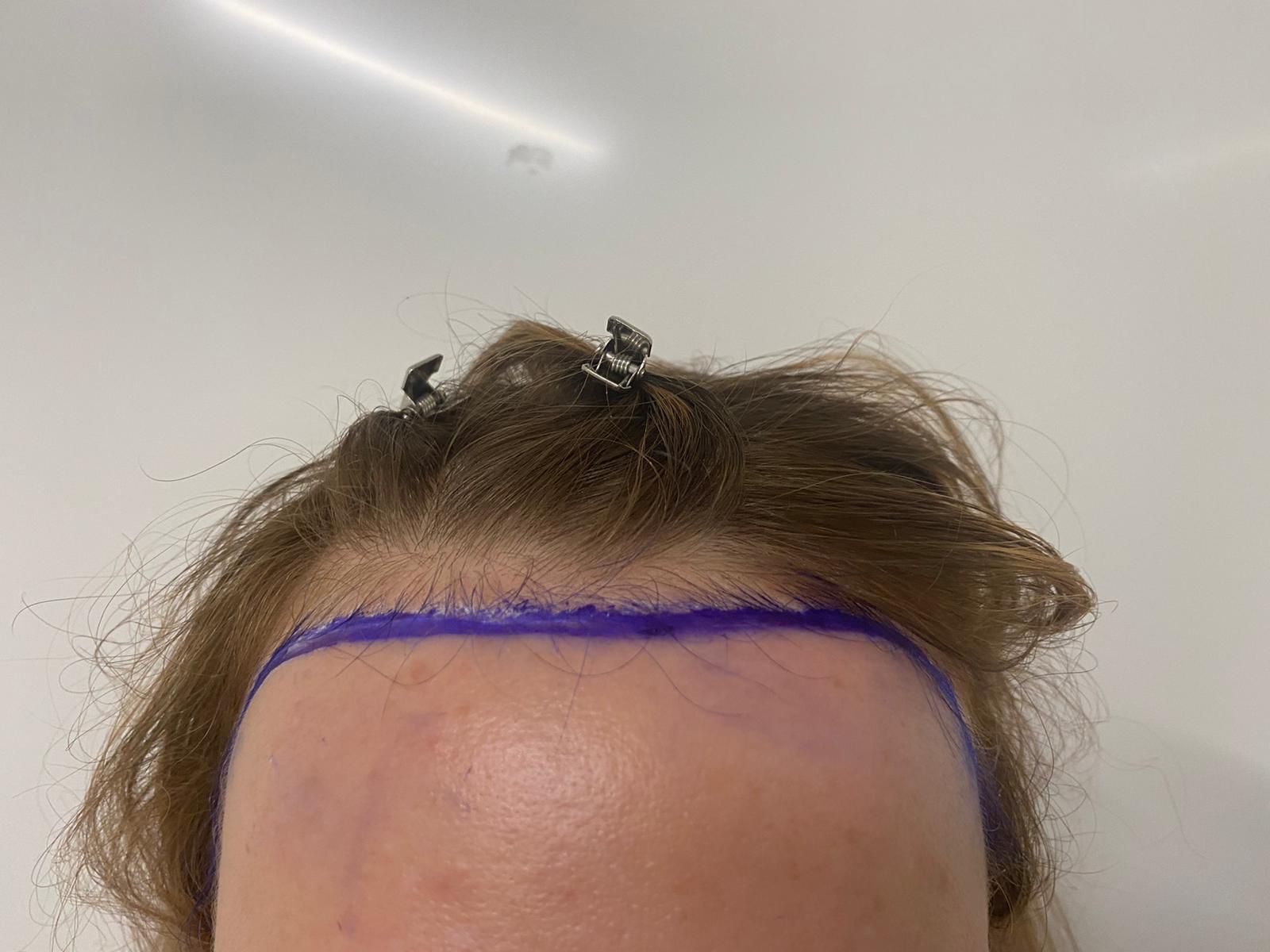 A female patient marked up prior to undergoing a FUE hair transplant
