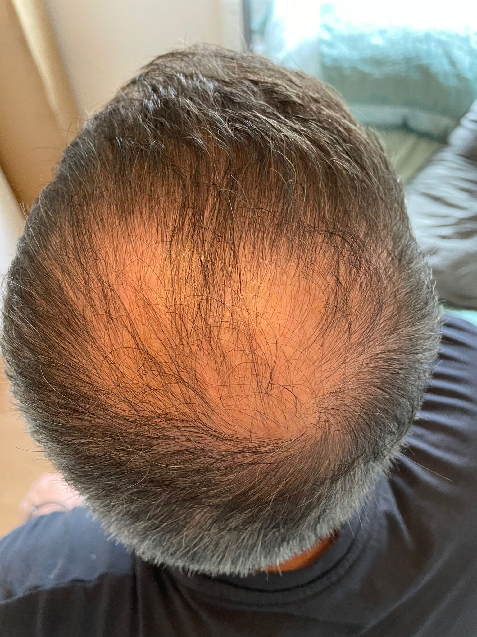 a picture of a patient with crown male pattern baldness