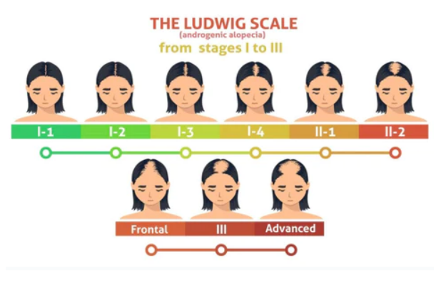 Ludwig scale illustration showing patterns of hair thinning in women