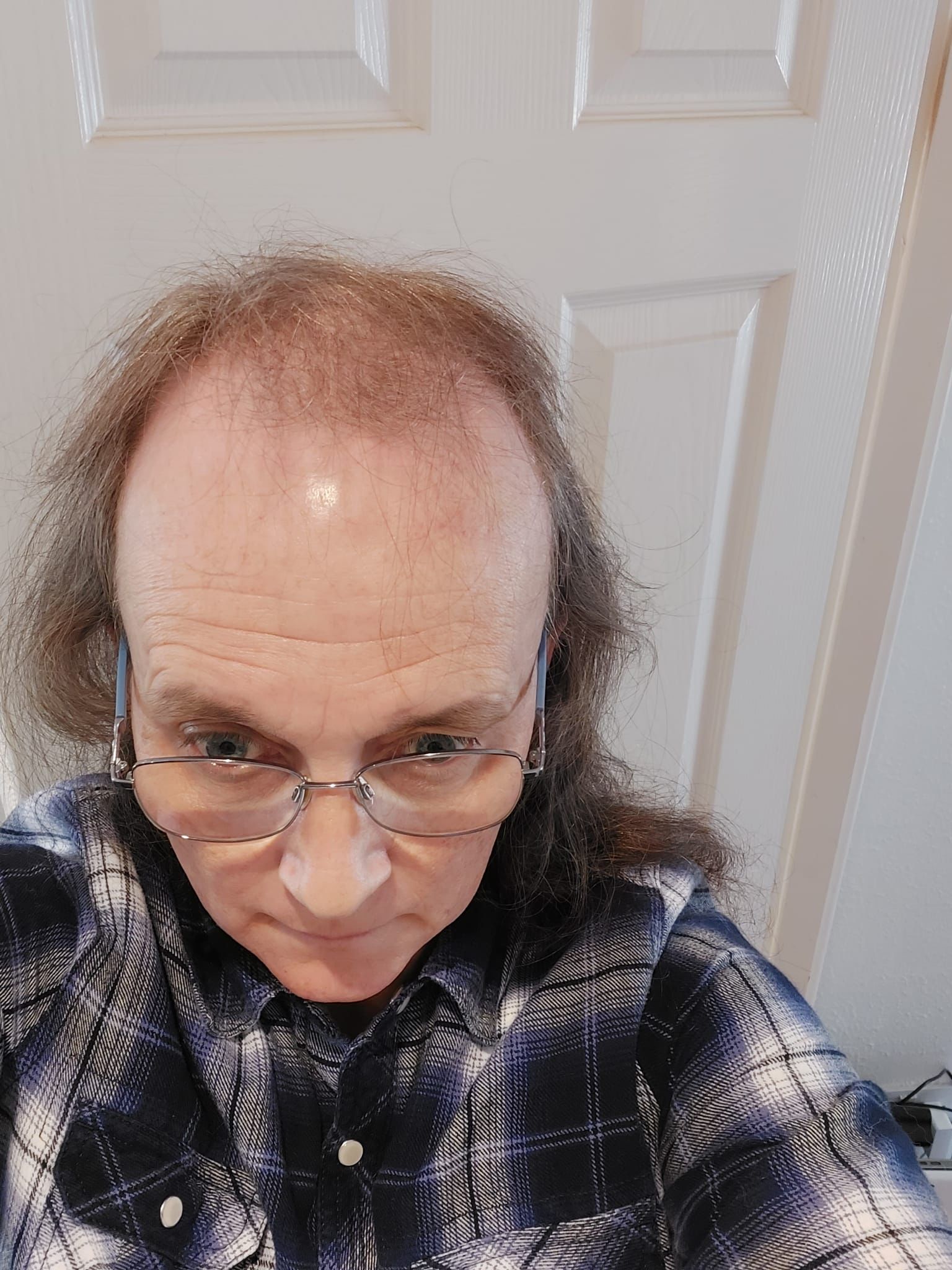 Liverpool transgender hair transplant result image 1