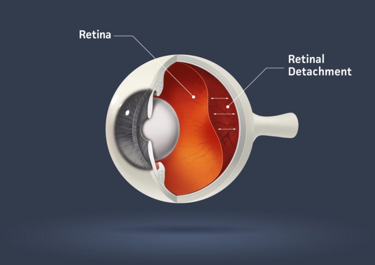 a diagram of a human eye showing the retina and retinal detachment