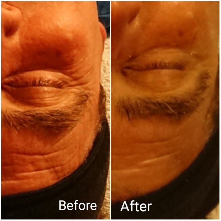 microdermabrasion