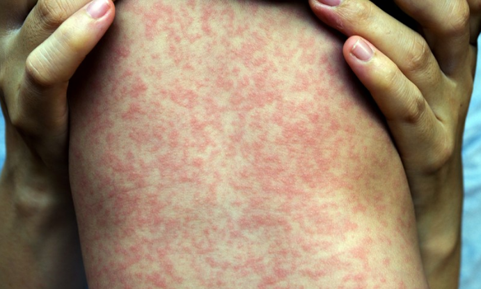 A person is holding a person 's leg with red spots on it.