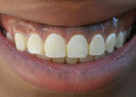 Smile Gallery