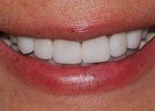 Smile Gallery