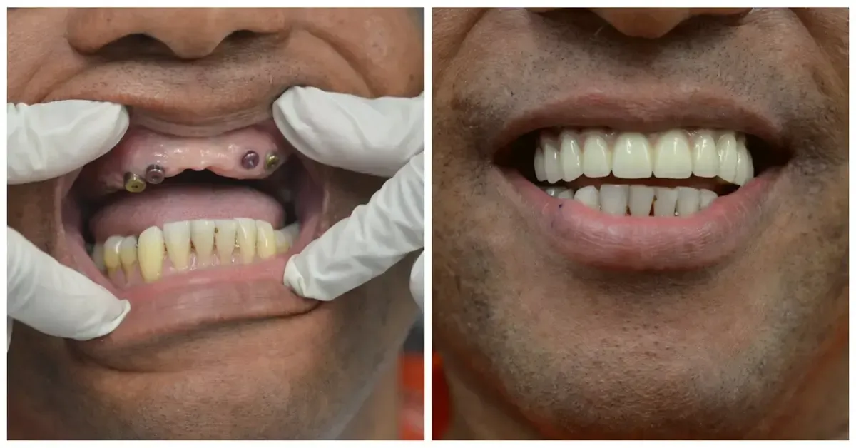 A before and after picture of a man 's teeth.