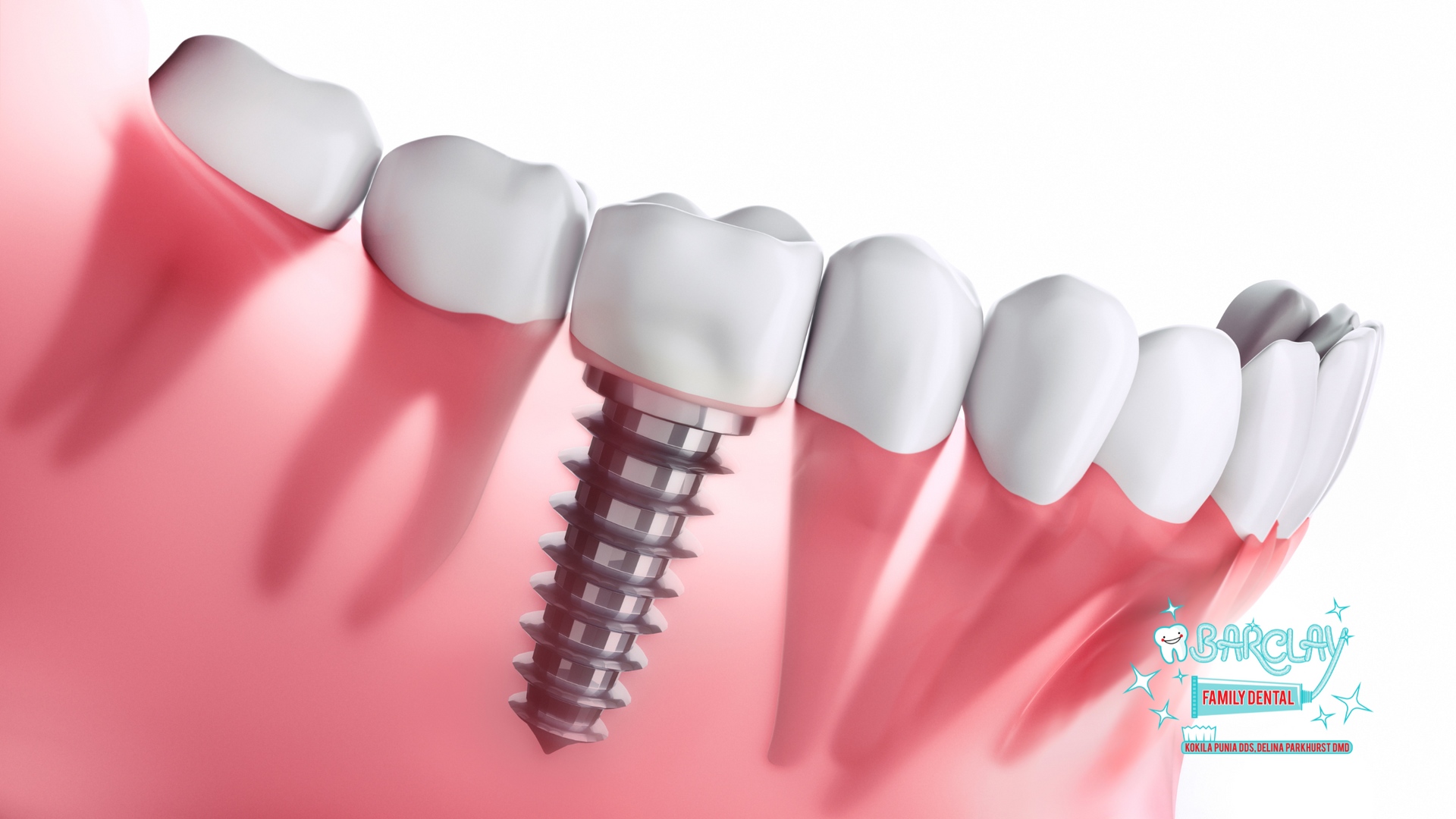 Dental implant in jaw: metal screw with attached white crown, surrounded by natural teeth.