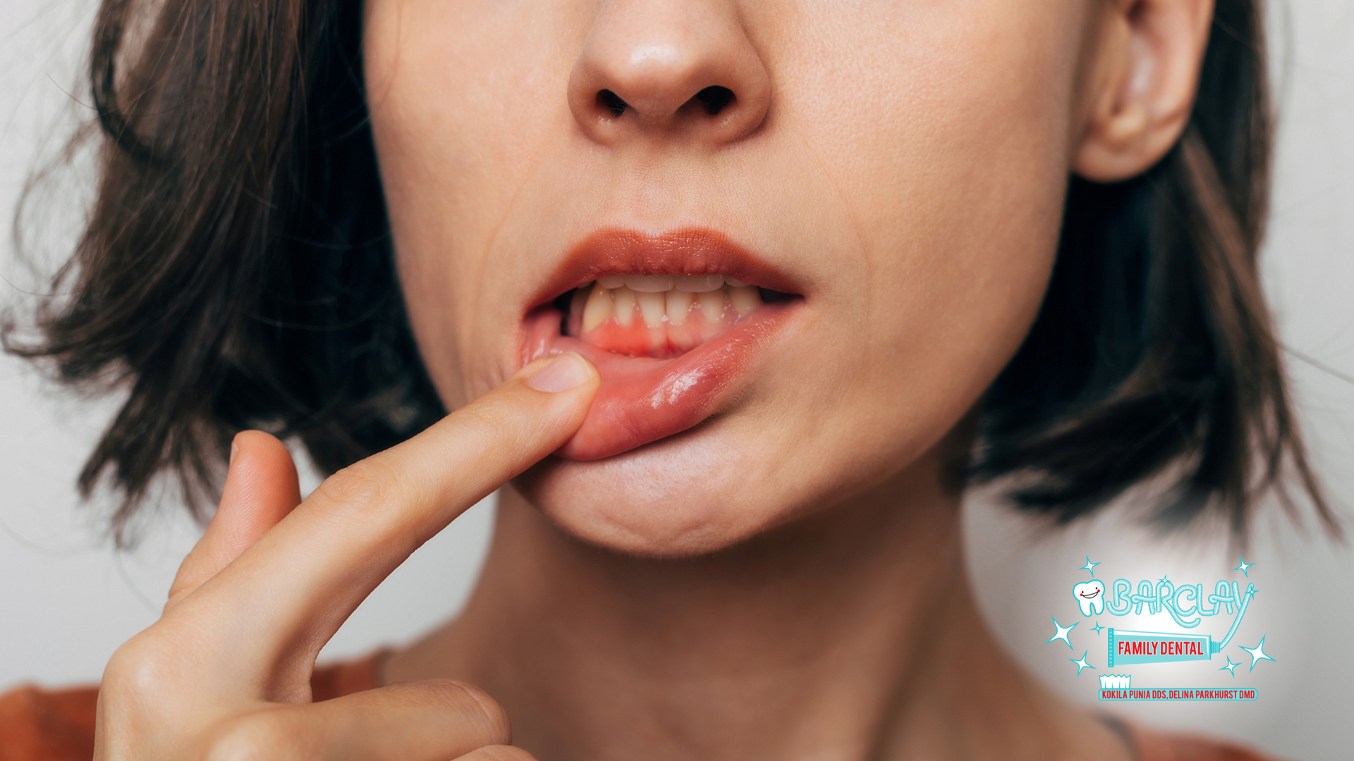 Woman pointing to inflamed gum area near her lip.
