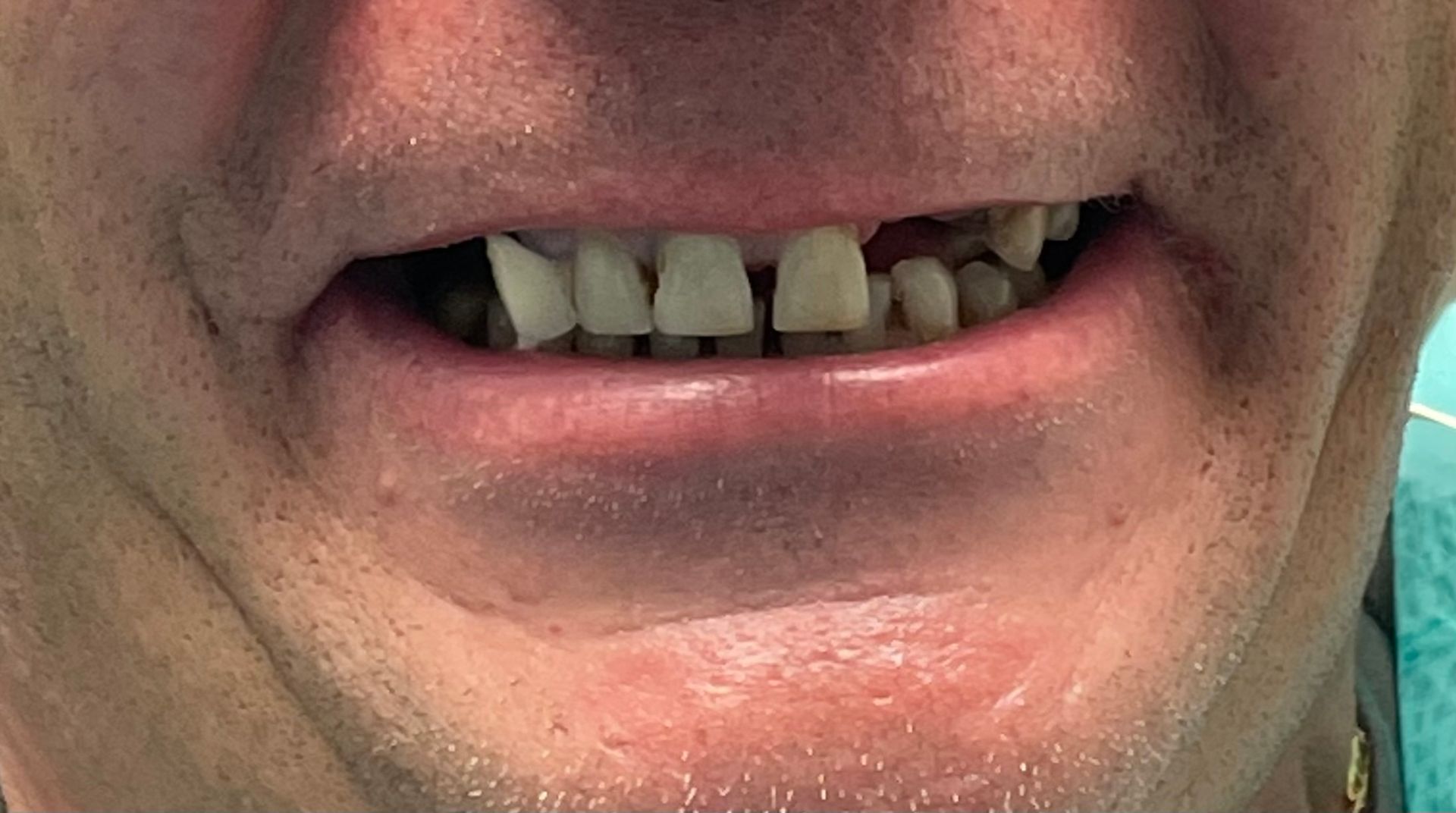 Close-up of a person's open mouth, showing crooked and missing teeth.