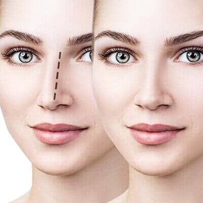 Rhinoplasty – Danvers, MA – North Shore Facial Plastic Surgery