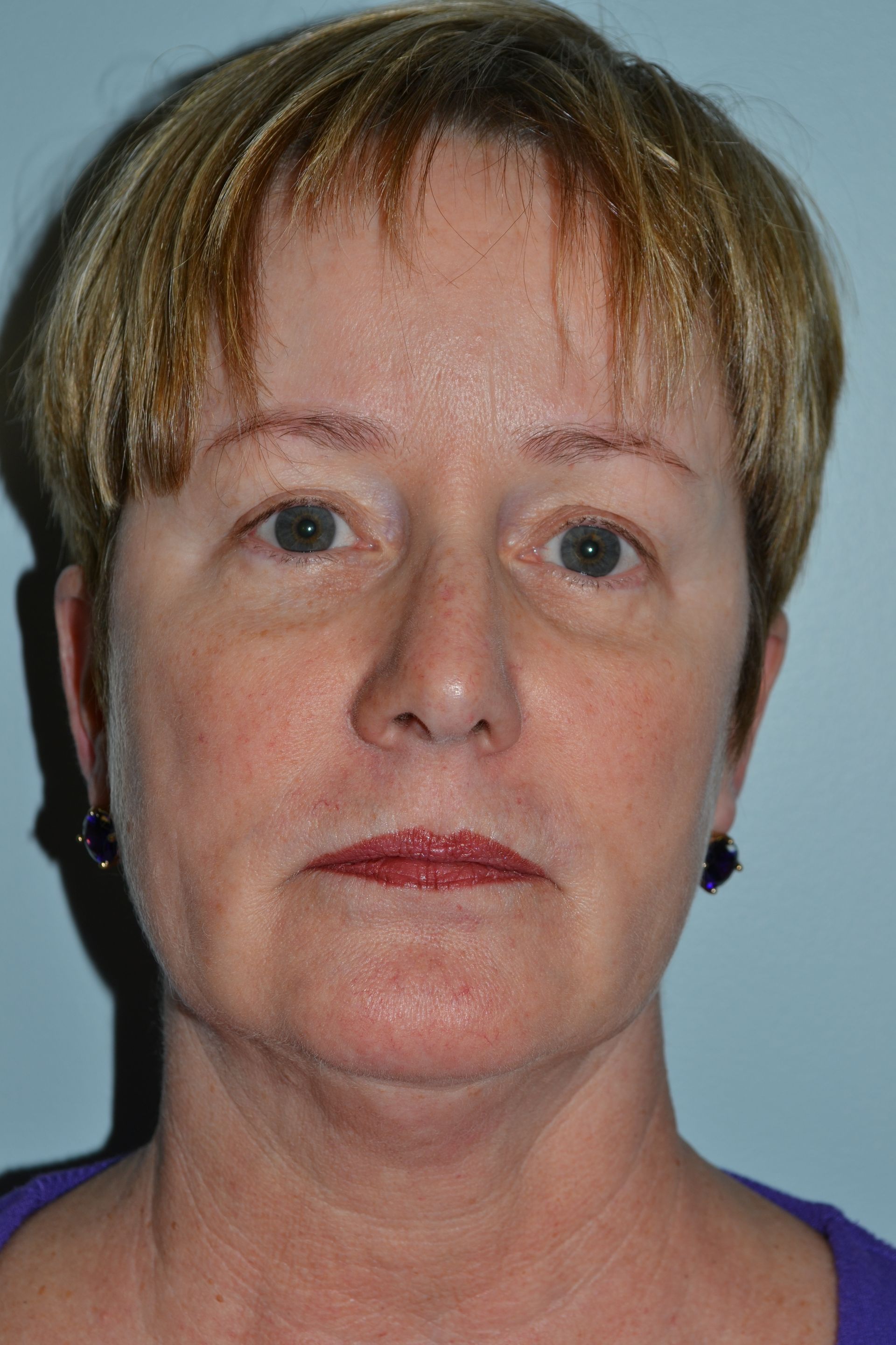 Facelifts Procedure 5 — North Shore Facial Plastic Surgery — Danvers, MA