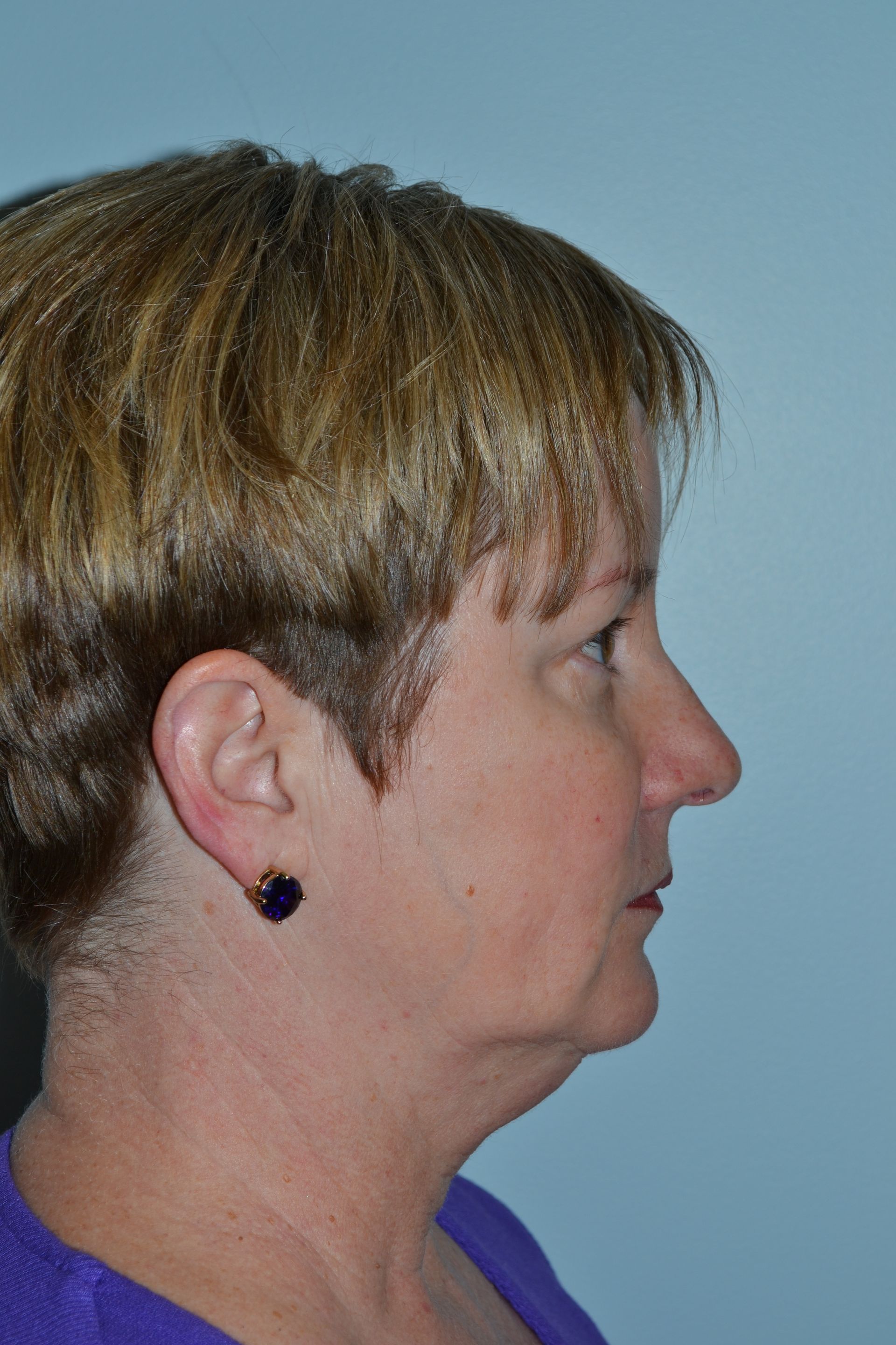 Facelifts Procedure 5 — North Shore Facial Plastic Surgery — Danvers, MA