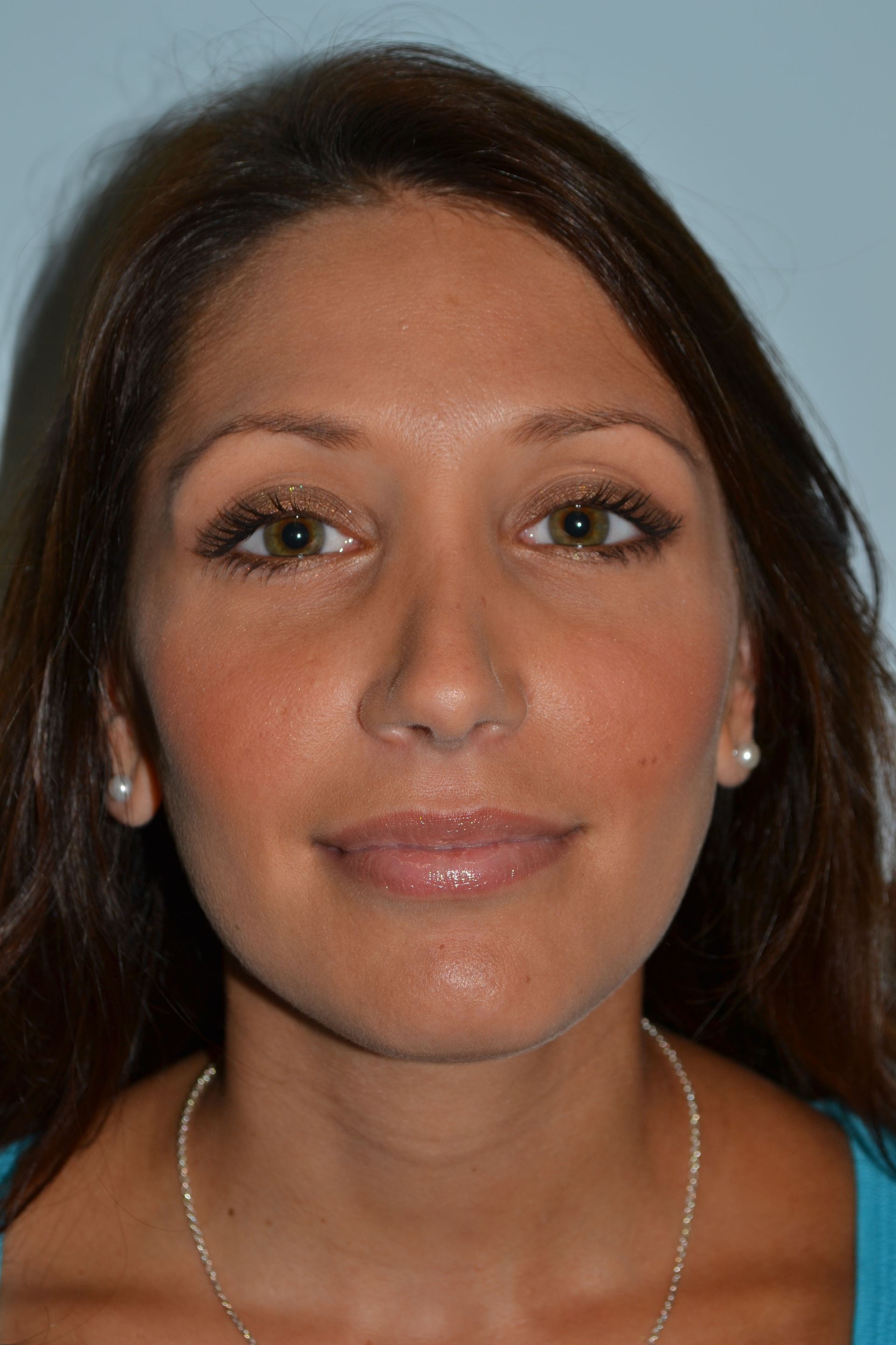 Rhinoplasty Procedure 1 — North Shore Facial Plastic Surgery — Danvers, MA