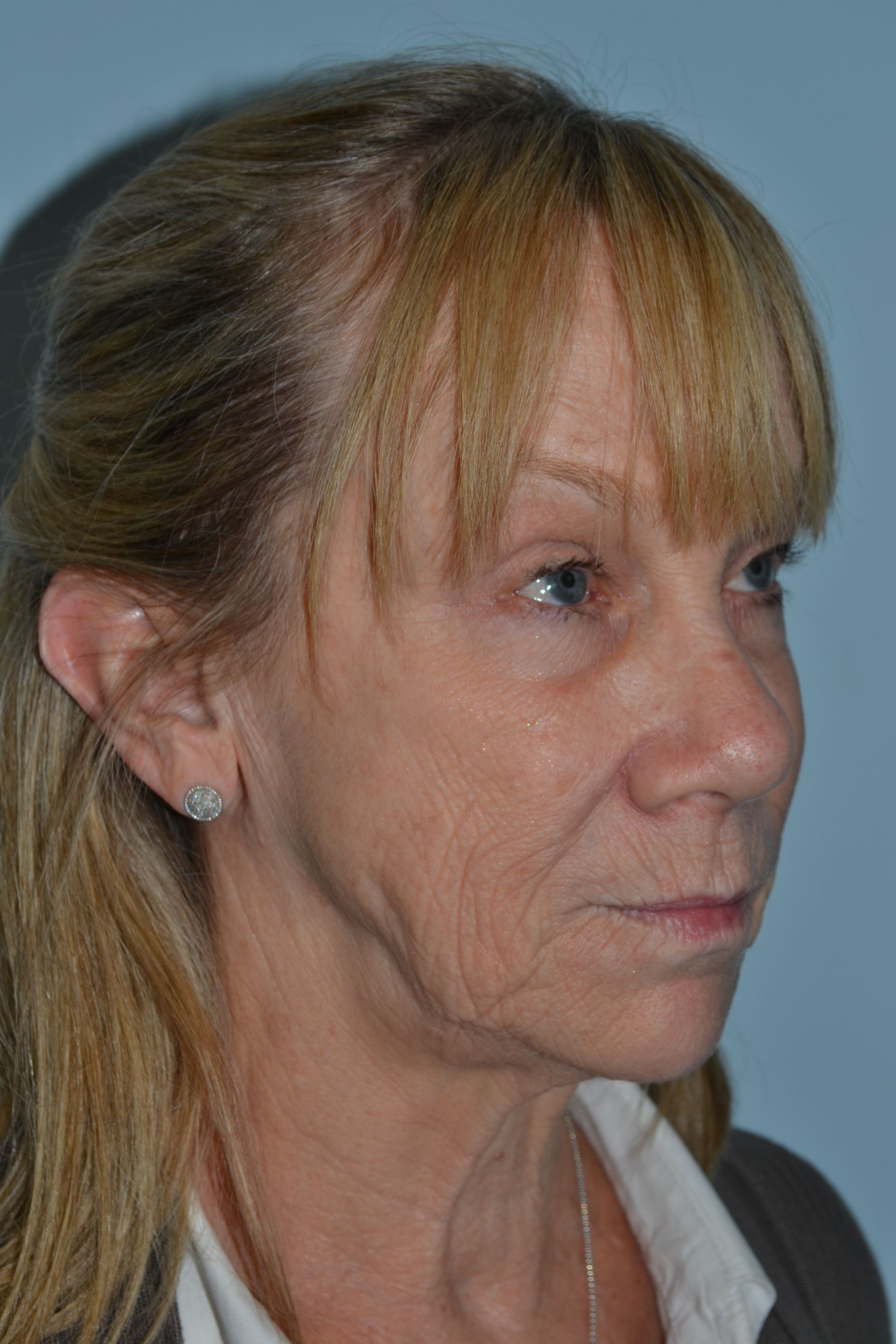 Facelifts Procedure 1 — North Shore Facial Plastic Surgery — Danvers, MA