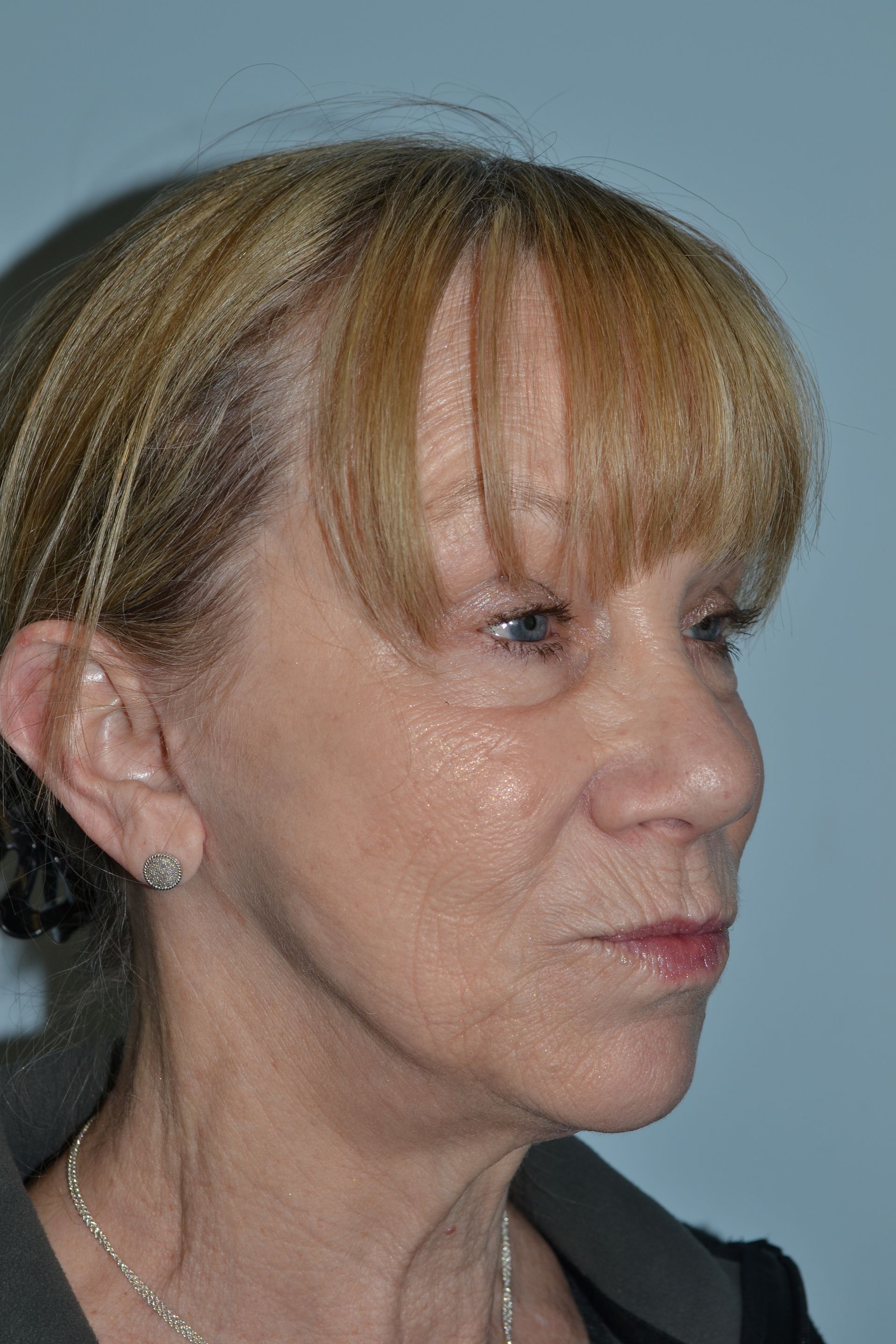Facelifts Procedure 2 — North Shore Facial Plastic Surgery — Danvers, MA