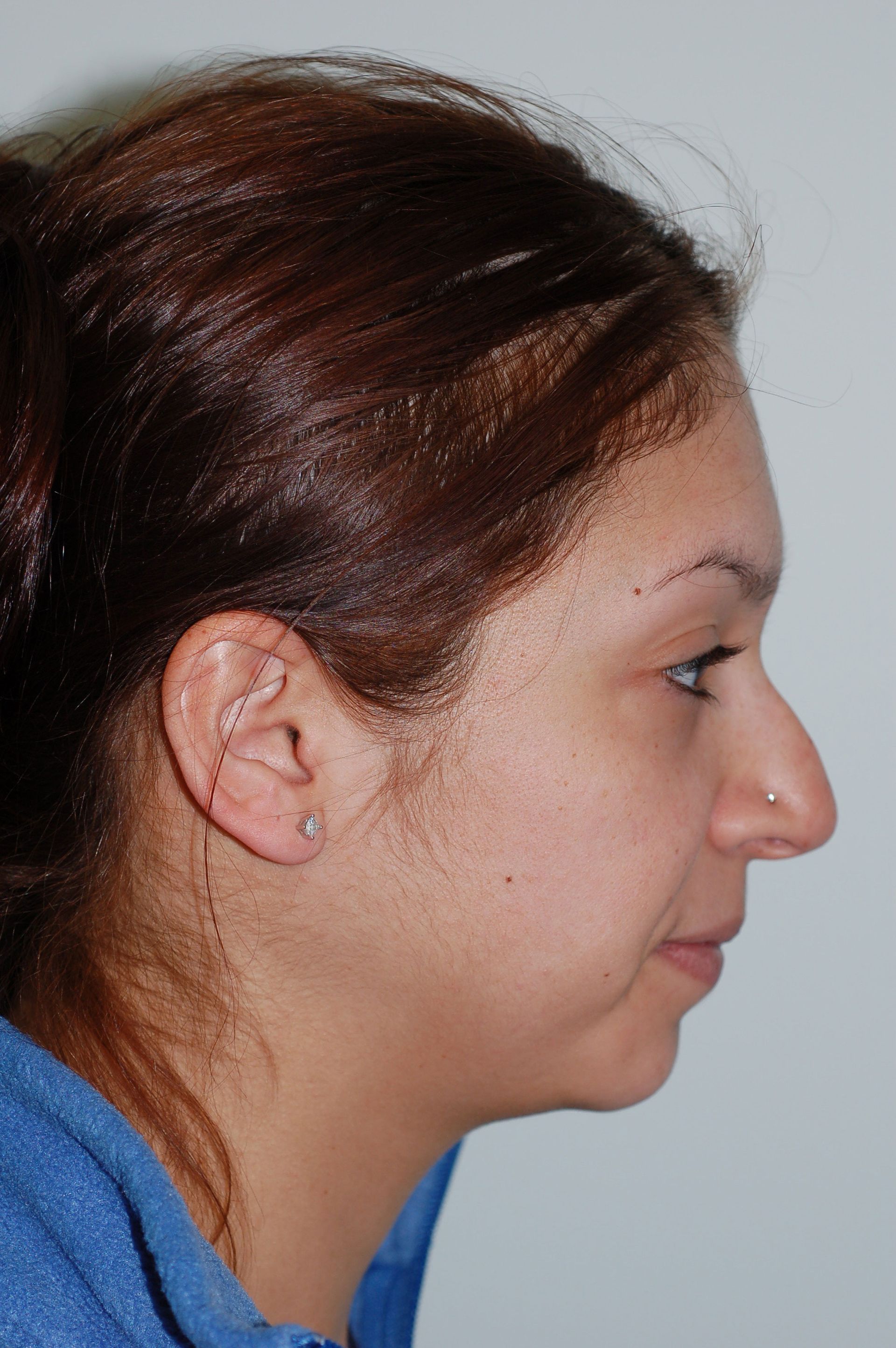 Rhinoplasty Procedure 17 — North Shore Facial Plastic Surgery — Danvers, MA