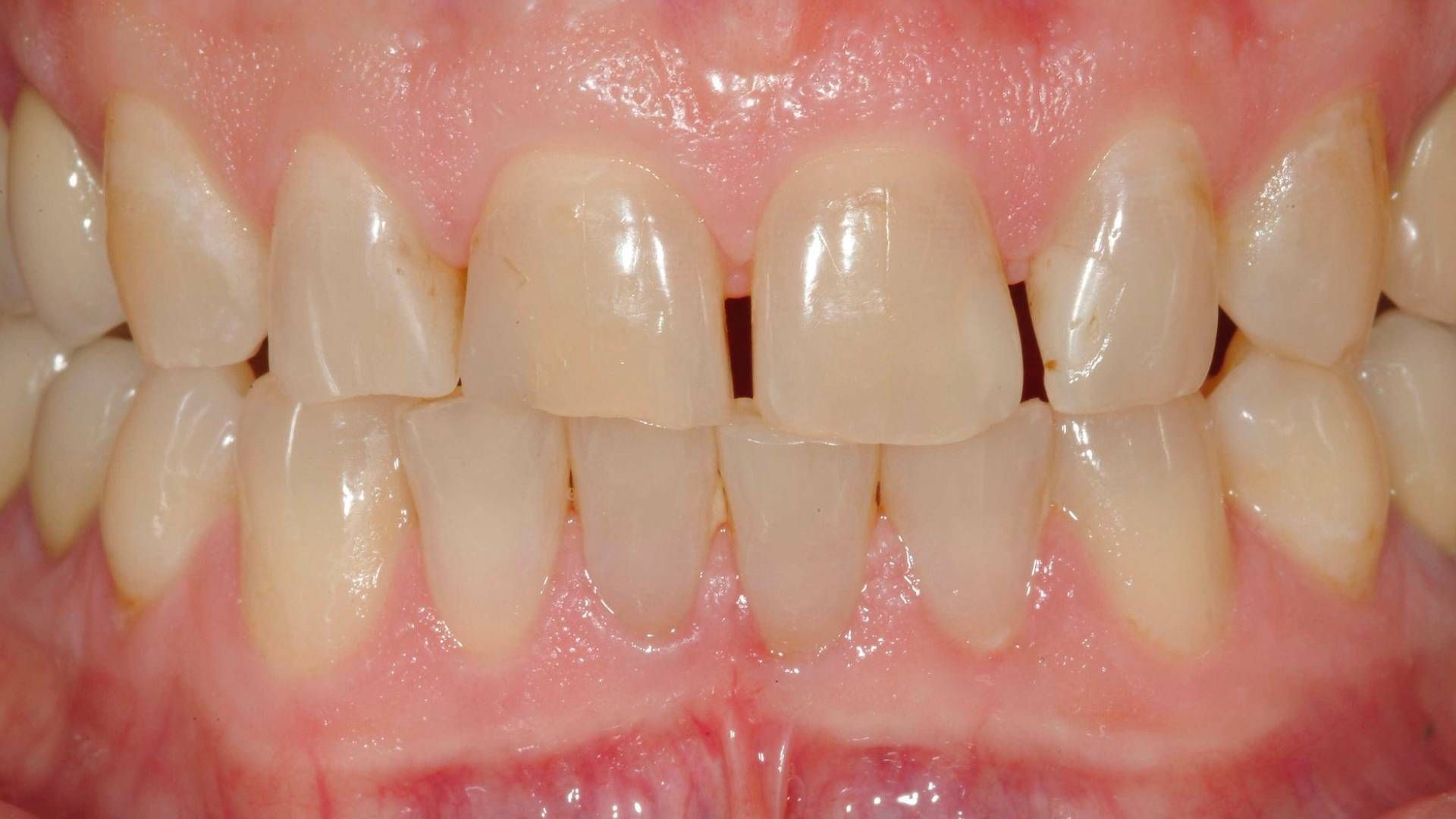 Composites cas 1 avant
