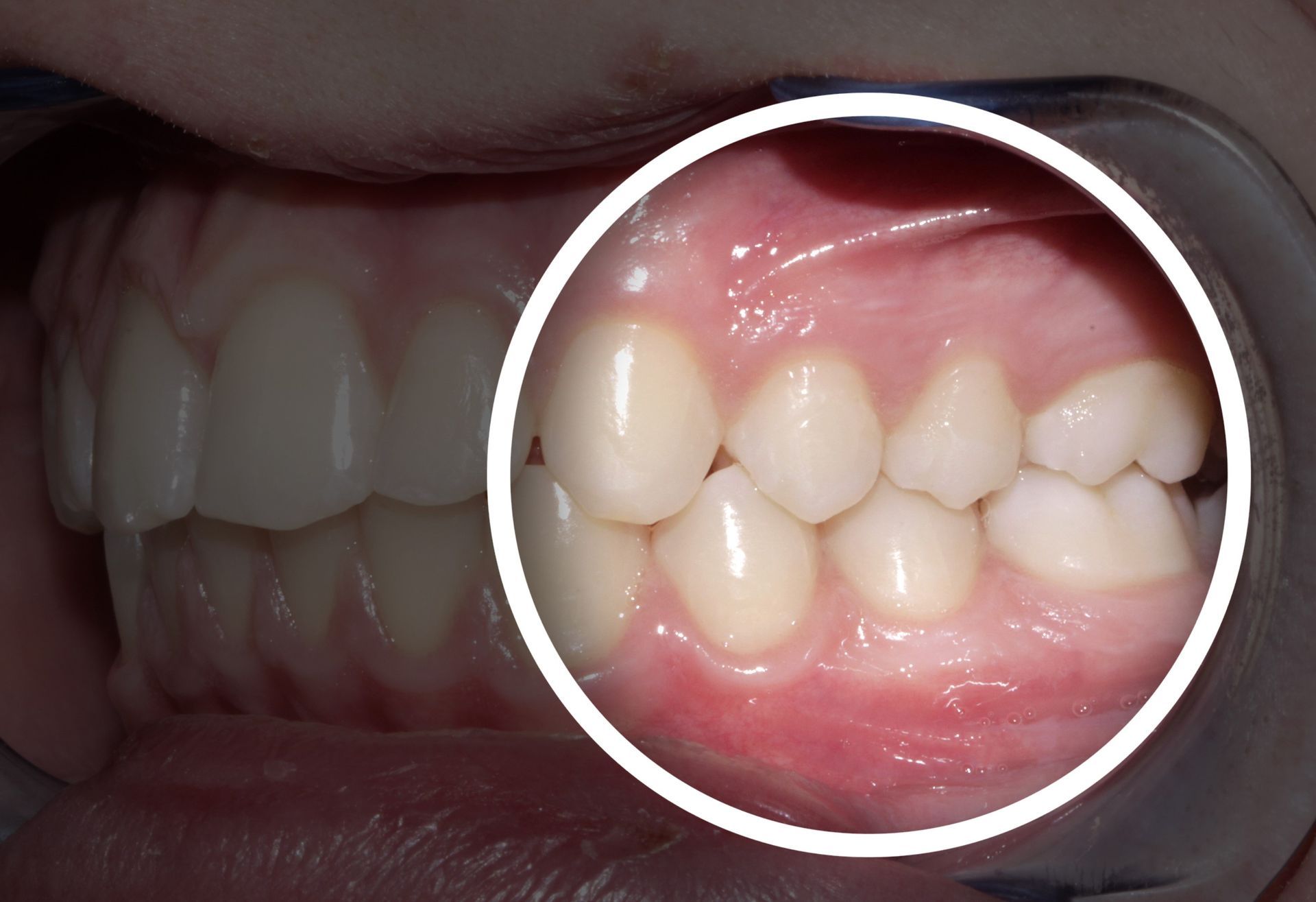 A close up of a person 's teeth with a white circle around them