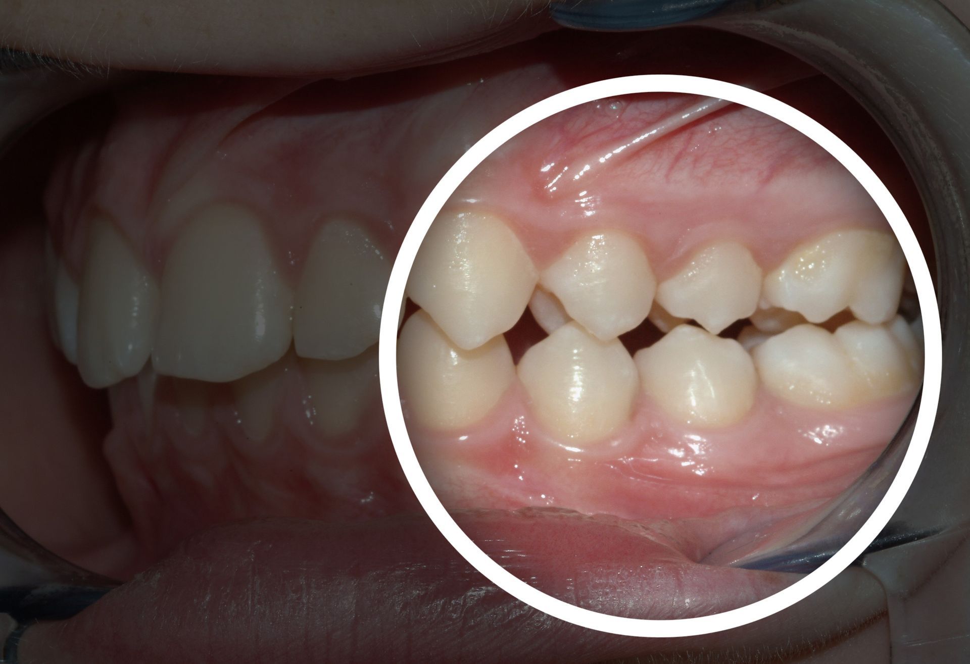 A close up of a person 's teeth with a white circle around them.