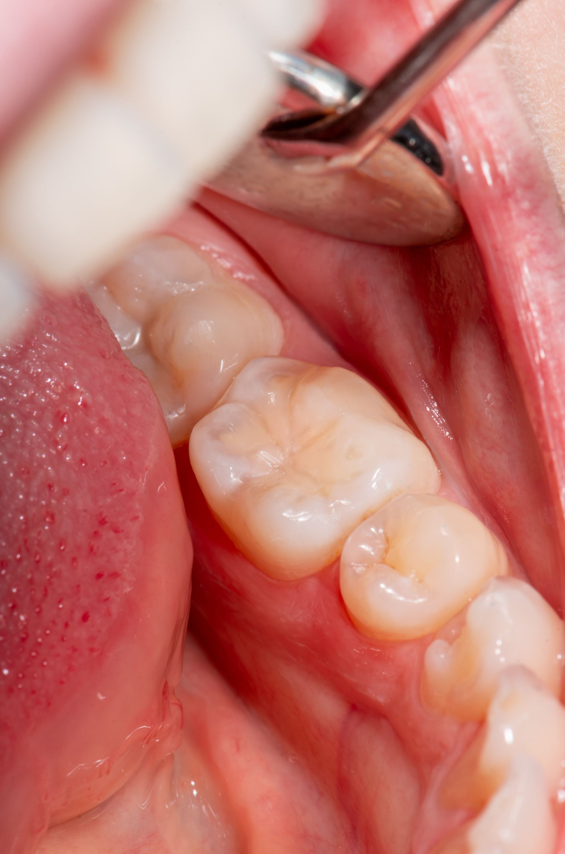 A close up of a person 's teeth being examined by a dentist.