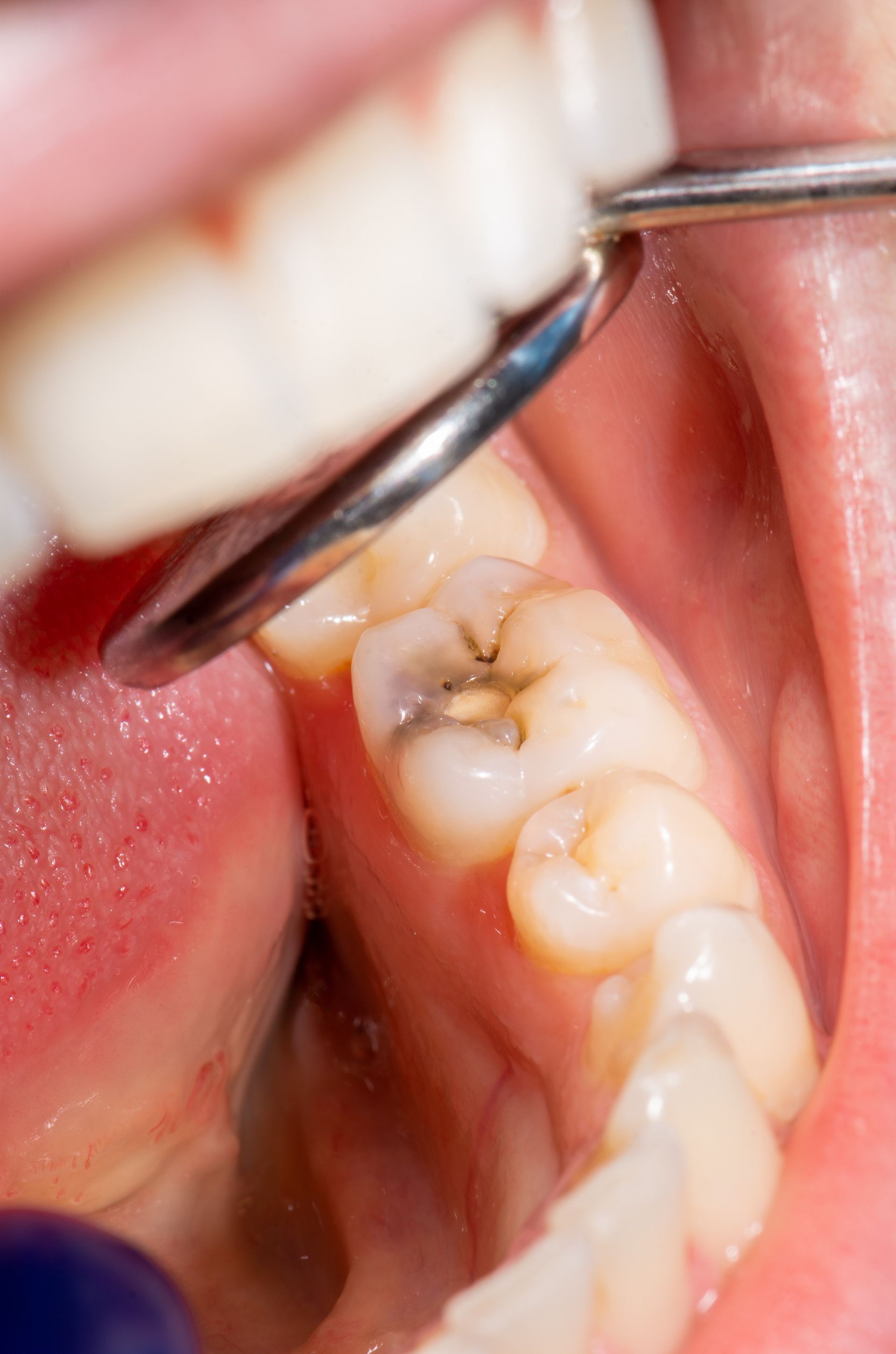 A close up of a tooth with a hole in it being examined by a dentist.
