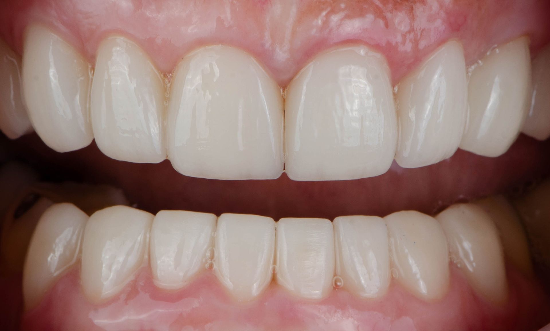 A close up of a person 's teeth with white teeth.