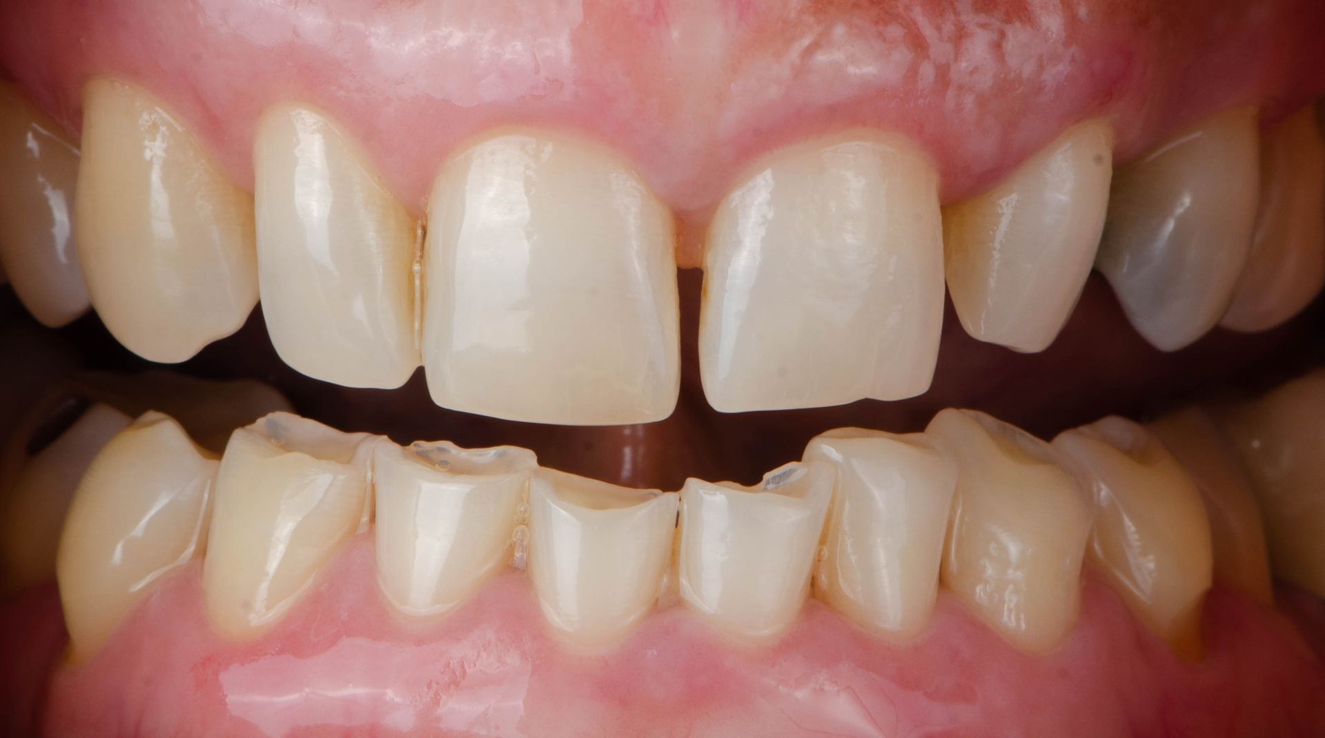 A close up of a person 's teeth with a broken tooth.