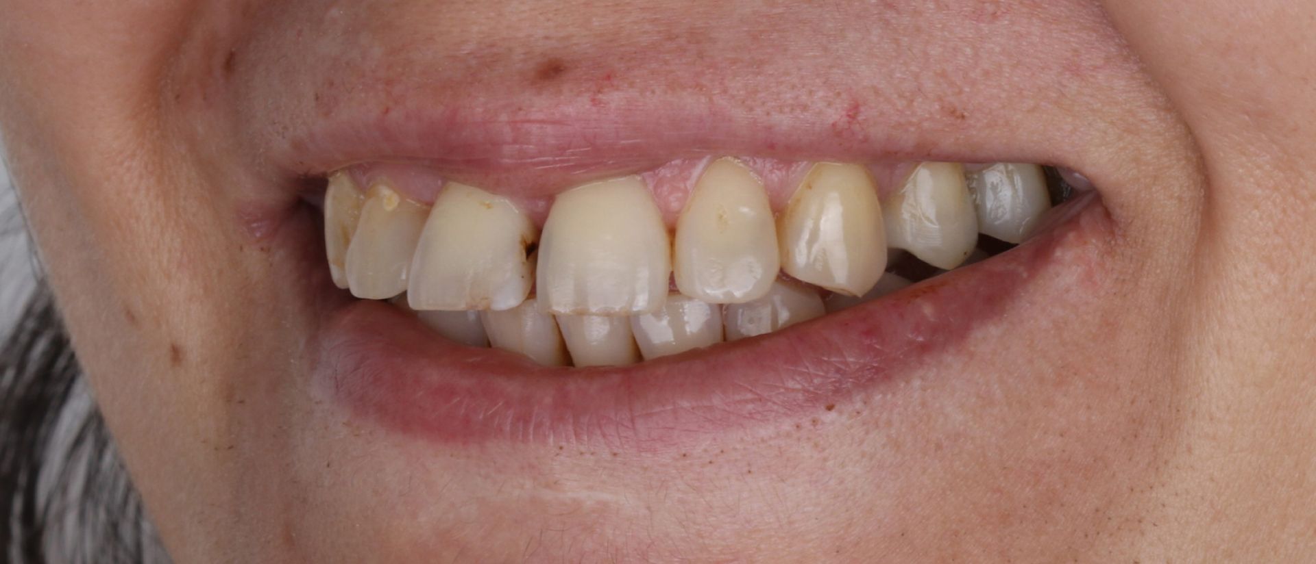 A close up of a woman 's teeth with a smile on her face.