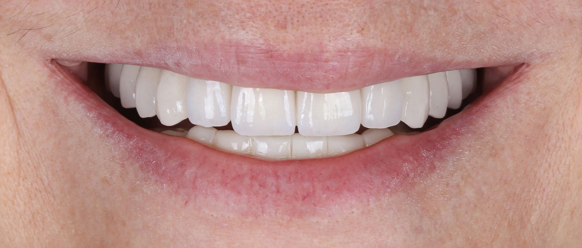 A close up of a man 's smile with white teeth.