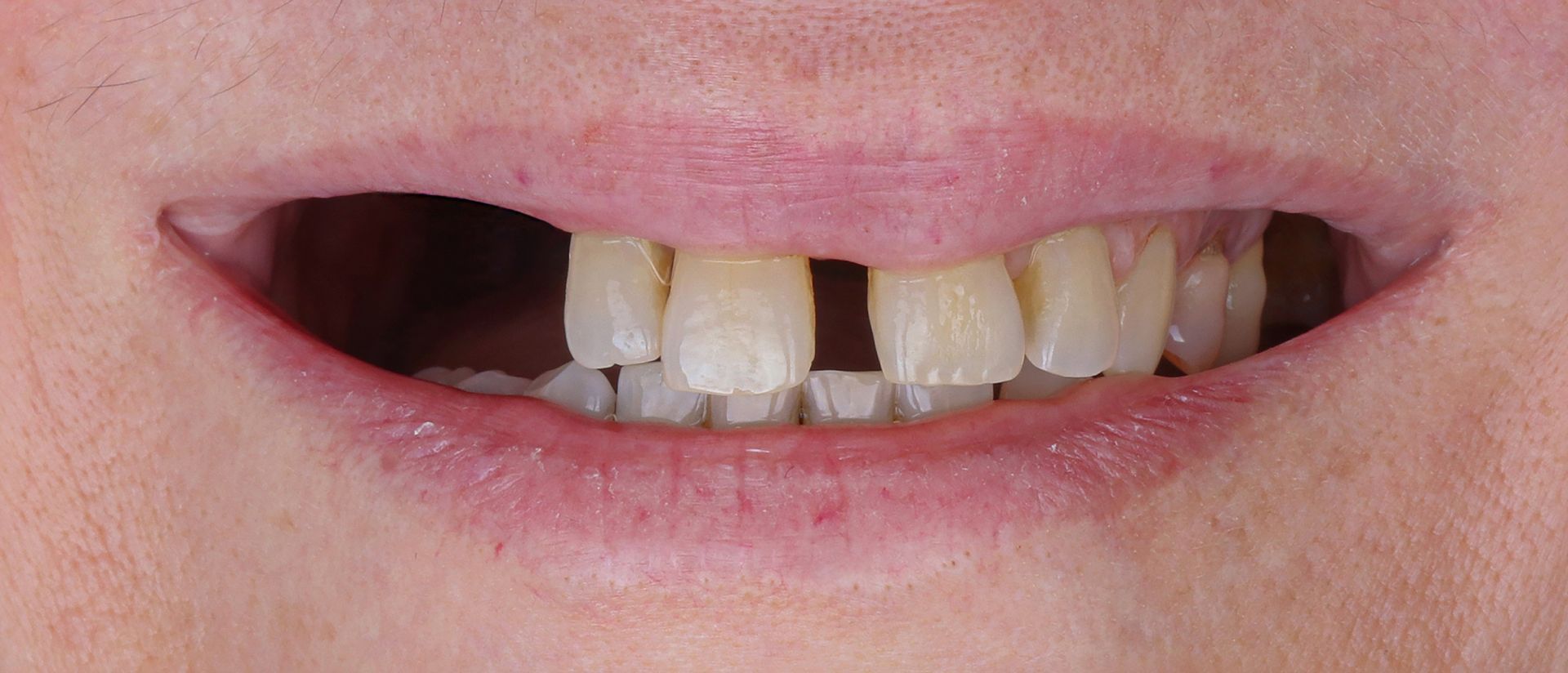 A close up of a person 's mouth with missing teeth.