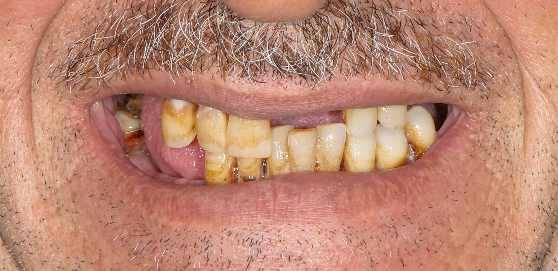 A close up of a man 's mouth with a beard and missing teeth.