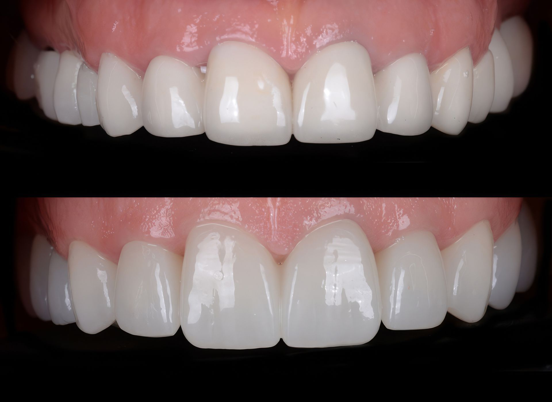 Aesthetic treatment of crooked and deformed teeth using porcelain veneers.