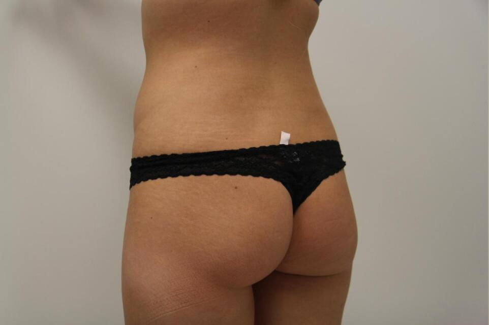 Side view of a person's torso and buttocks in black thong underwear against a light background.