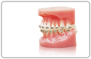 Metal Braces Metal Braces