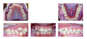 Before Orthodontics