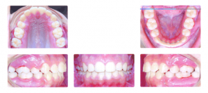 After Orthodontics