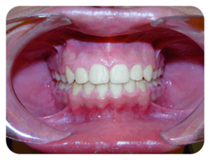 Teeth Frontal View