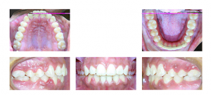 After Orthodontics