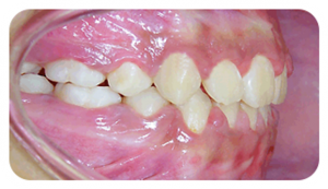 Left Buccal View