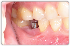 Gum With Dental Implant Gum With Dental Implant