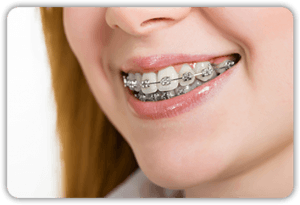 Woman With Braces Woman With Braces